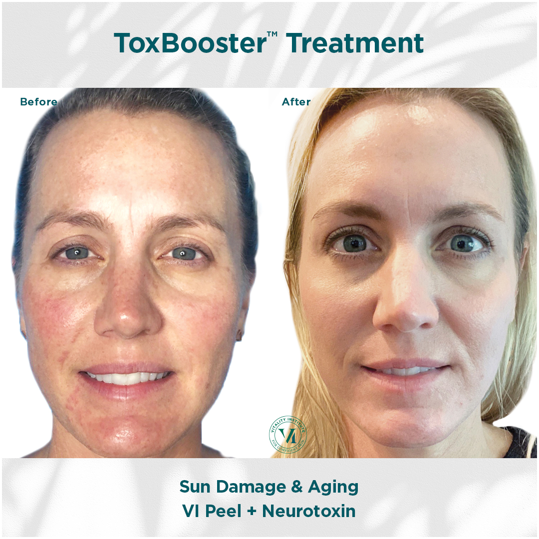Chemical Peels